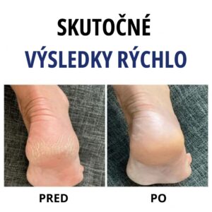 Komplet pre starostlivosť o nohy - HeelRecover - Image 5